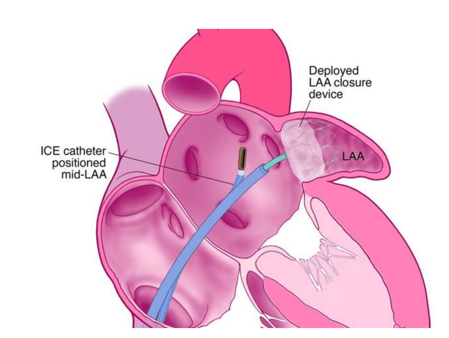 Left Atrial Appendage (LAA) Closure