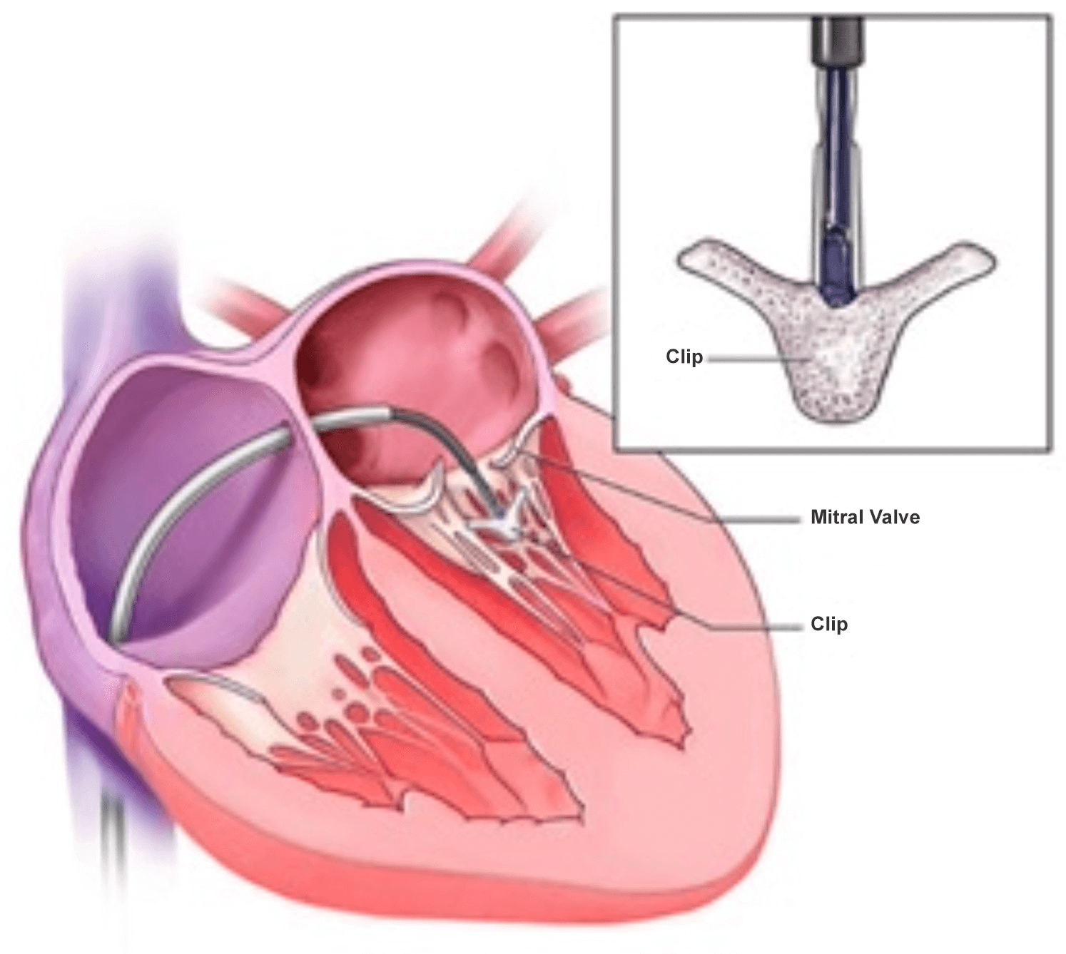 Mitral Valve Clip Therapy for Mitral Valve Repair