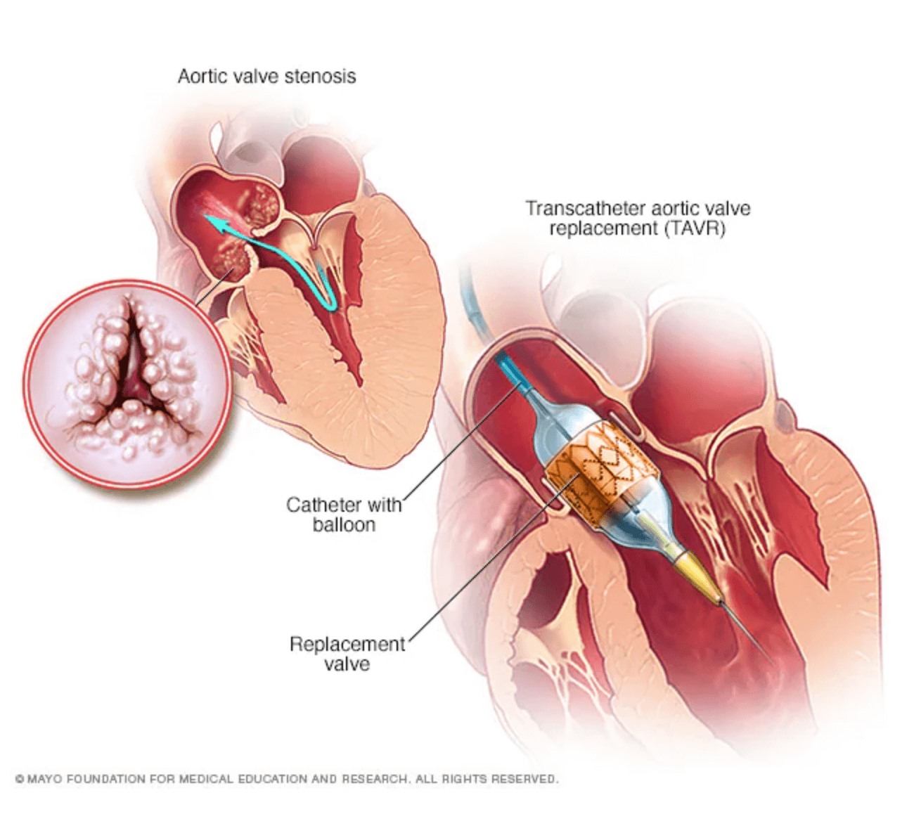 Transcatheter aortic valve replacement (TAVR)