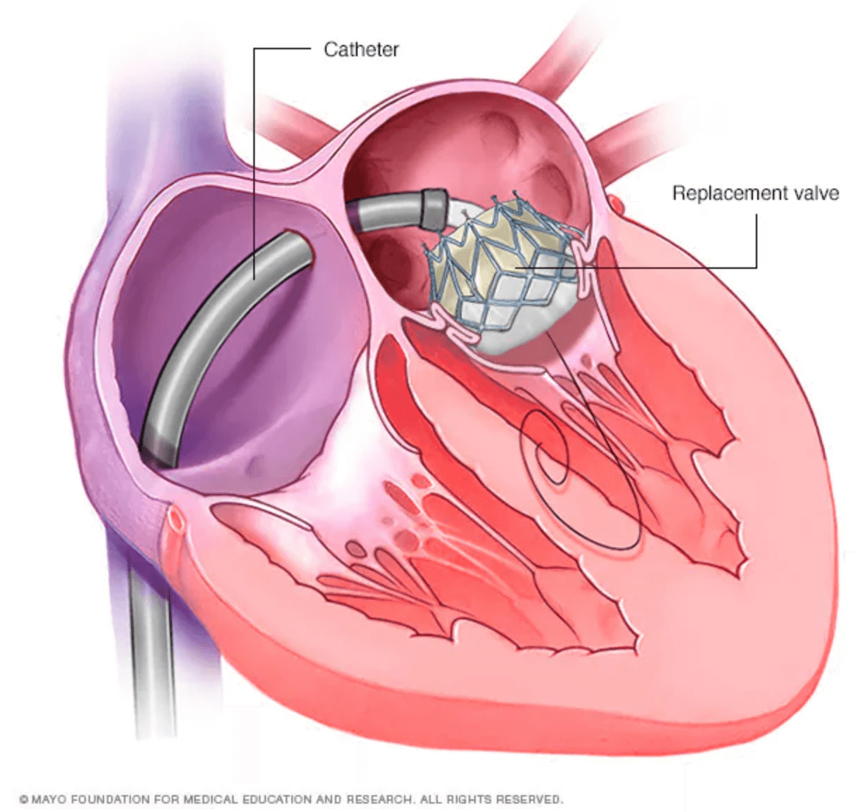 Transcatheter Mitral Valve (TMVR)